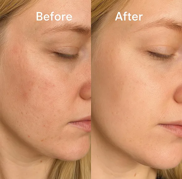 thenurave-Lightweight Hydration & Comfort Before & After Transformation N